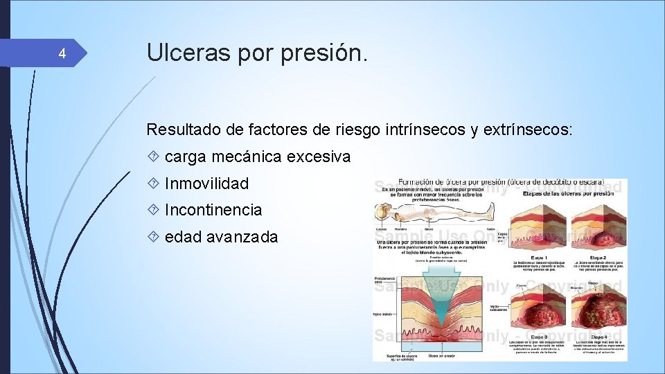 4 Ulceras por presión. Resultado de factores de riesgo intrínsecos y extrínsecos: carga mecánica