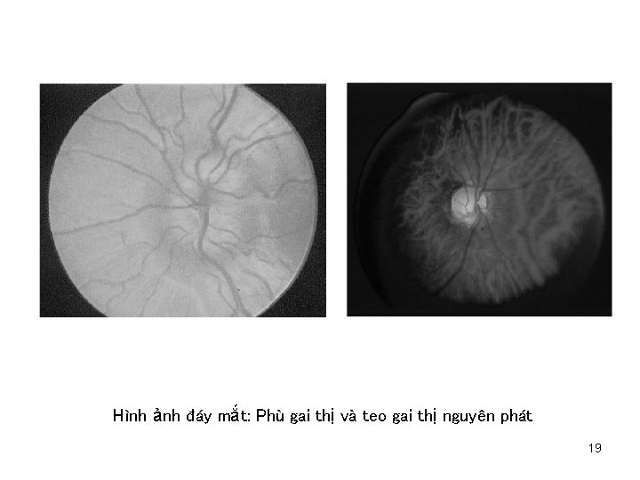 Hình ảnh đáy mắt: Phù gai thị và teo gai thị nguyên phát 19