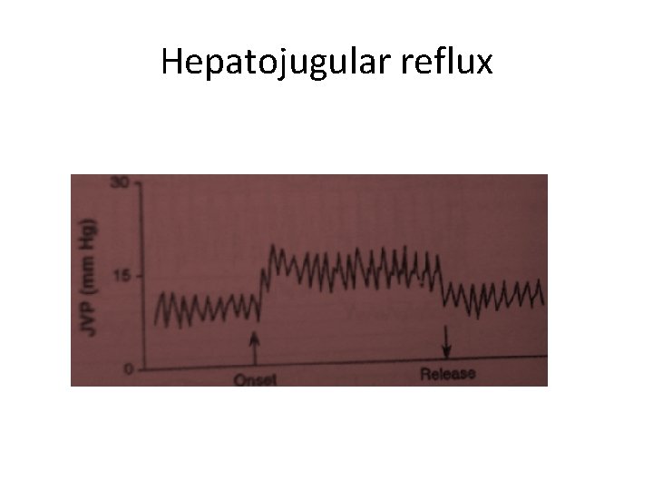 Hepatojugular reflux 