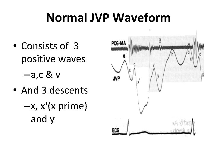 Normal JVP Waveform • Consists of 3 positive waves – a, c & v