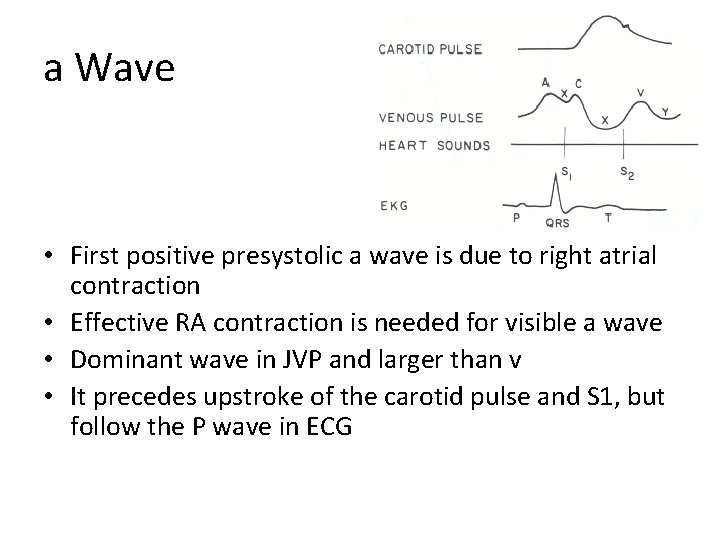 a Wave • First positive presystolic a wave is due to right atrial contraction a Wave • First positive presystolic a wave is due to right atrial contraction
