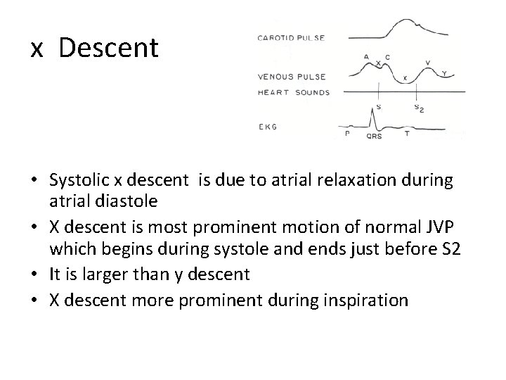 x Descent • Systolic x descent is due to atrial relaxation during atrial diastole x Descent • Systolic x descent is due to atrial relaxation during atrial diastole
