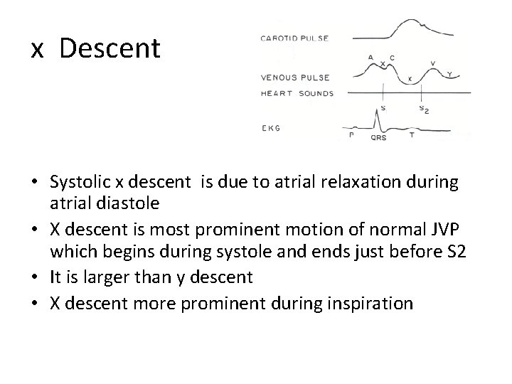 x Descent • Systolic x descent is due to atrial relaxation during atrial diastole