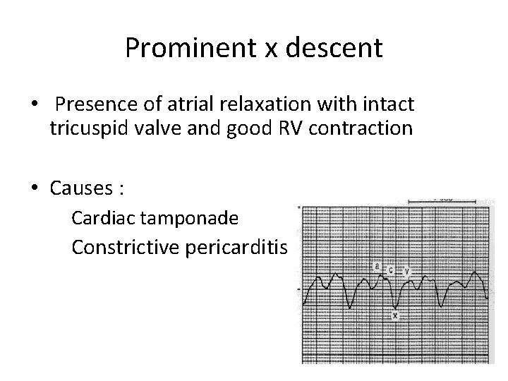 Prominent x descent • Presence of atrial relaxation with intact tricuspid valve and good