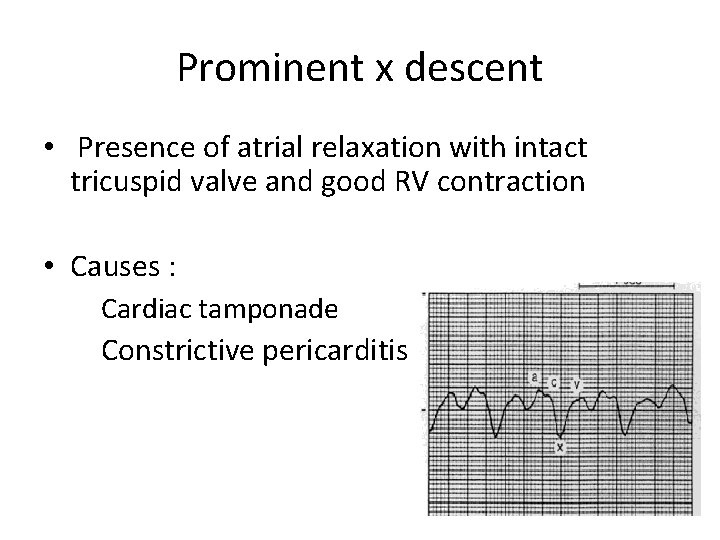 Prominent x descent • Presence of atrial relaxation with intact tricuspid valve and good Prominent x descent • Presence of atrial relaxation with intact tricuspid valve and good
