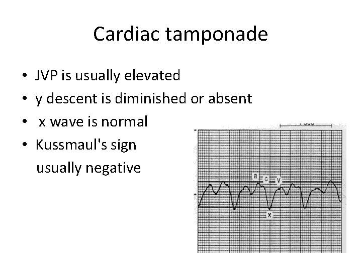 Cardiac tamponade • • JVP is usually elevated y descent is diminished or absent