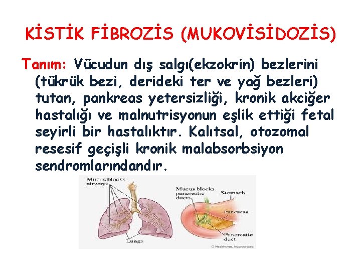 KİSTİK FİBROZİS (MUKOVİSİDOZİS) Tanım: Vücudun dış salgı(ekzokrin) bezlerini (tükrük bezi, derideki ter ve yağ