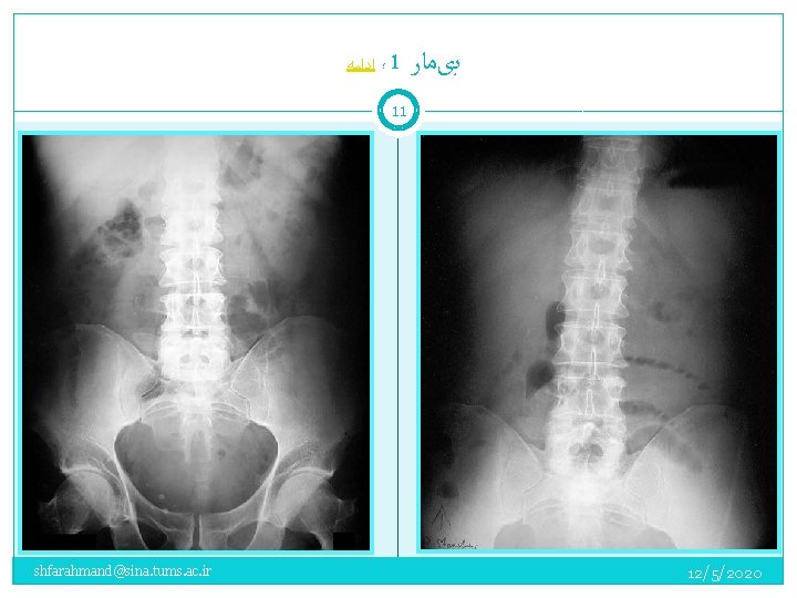  ؛ ﺍﺩﺍﻣﻪ 1 ﺑیﻤﺎﺭ 11 shfarahmand@sina. tums. ac. ir 12/5/2020 