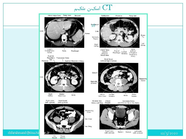  ﺍﺳکﻦ ﺷکﻢ CT 18 shfarahmand@sina. tums. ac. ir 12/5/2020 