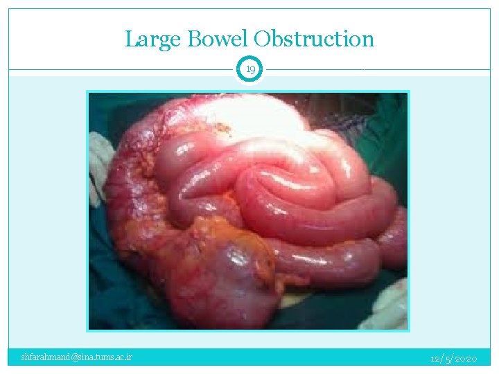 Large Bowel Obstruction 19 shfarahmand@sina. tums. ac. ir 12/5/2020 