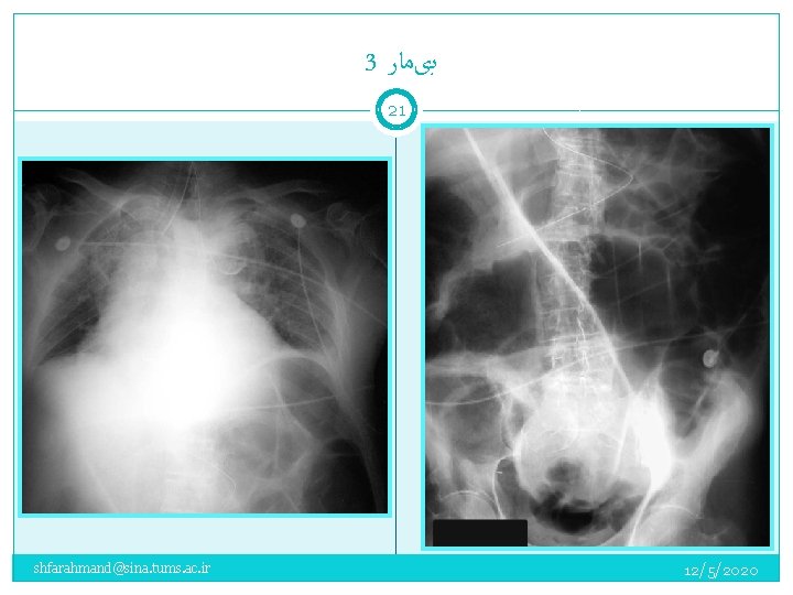 3 ﺑیﻤﺎﺭ 21 shfarahmand@sina. tums. ac. ir 12/5/2020 