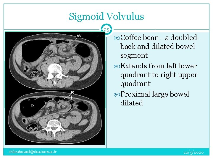 Sigmoid Volvulus 25 Coffee bean—a doubled- back and dilated bowel segment Extends from left