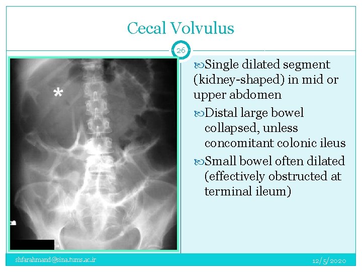 Cecal Volvulus 26 Single dilated segment (kidney-shaped) in mid or upper abdomen Distal large