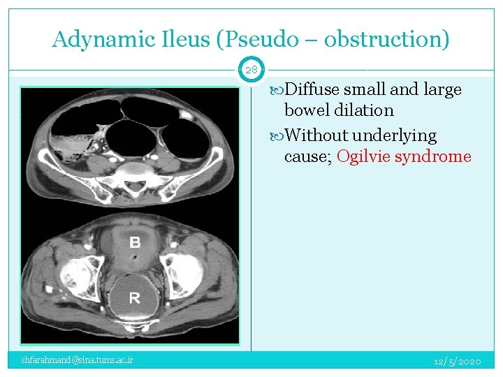 Adynamic Ileus (Pseudo – obstruction) 28 Diffuse small and large bowel dilation Without underlying