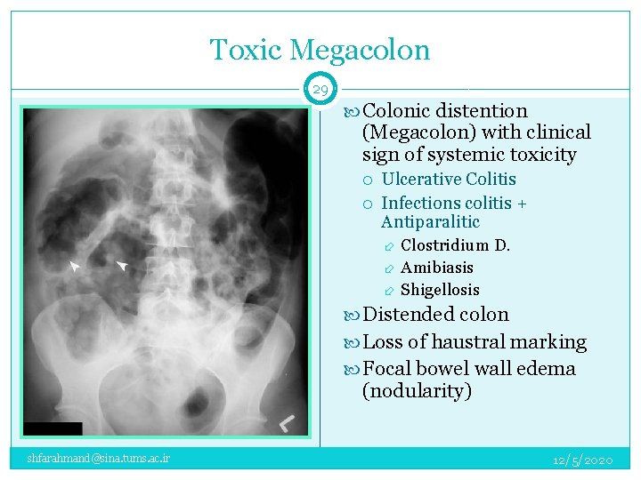 Toxic Megacolon 29 Colonic distention (Megacolon) with clinical sign of systemic toxicity Ulcerative Colitis