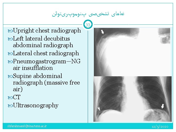 ﻧﻤﺎﻫﺎی ﺗﺸﺨیﺼی پﻨﻮﻣﻮپﺮیﺘﻮﺋﻦ 33 Upright chest radiograph Left lateral decubitus abdominal radiograph Lateral