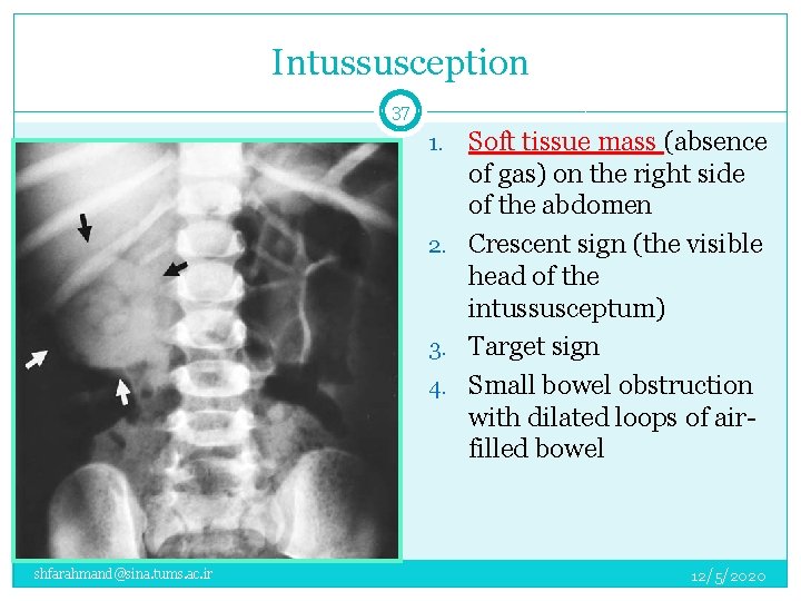 Intussusception 37 Soft tissue mass (absence of gas) on the right side of the