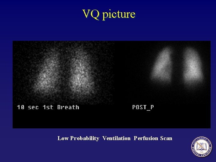 VQ picture Low Probability Ventilation Perfusion Scan 