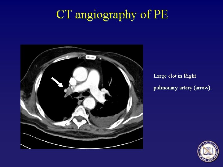 CT angiography of PE Large clot in Right pulmonary artery (arrow). 