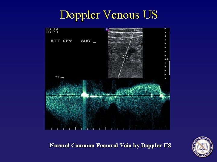 Doppler Venous US Normal Common Femoral Vein by Doppler US 