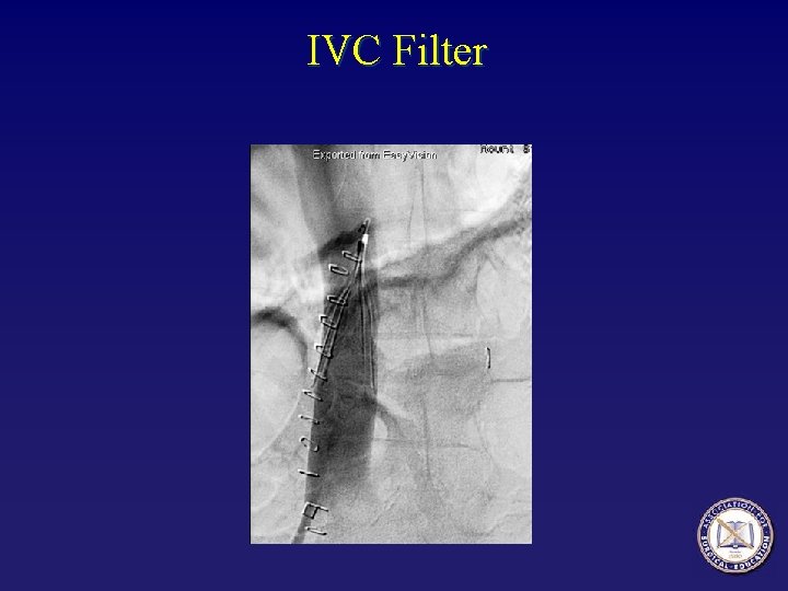IVC Filter 