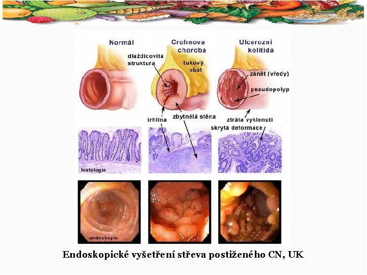 28 Endoskopické vyšetření střeva postiženého CN, UK 