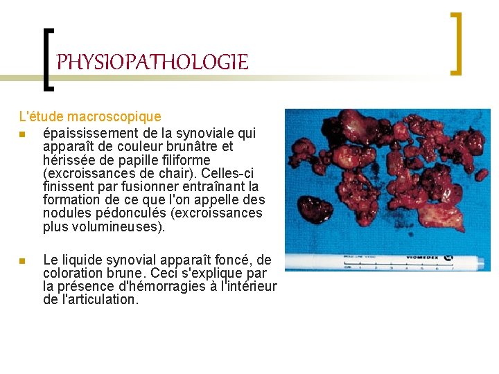 PHYSIOPATHOLOGIE L'étude macroscopique n épaississement de la synoviale qui apparaît de couleur brunâtre et