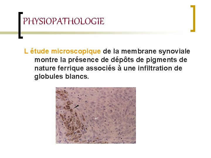 PHYSIOPATHOLOGIE L étude microscopique de la membrane synoviale montre la présence de dépôts de