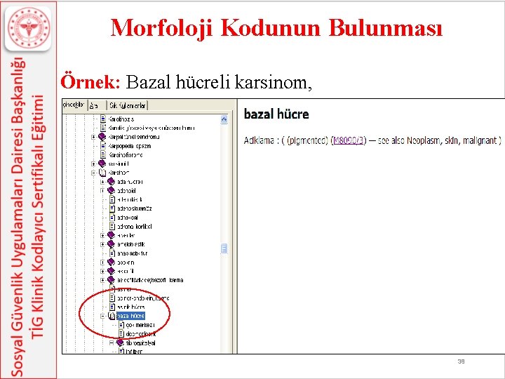 Morfoloji Kodunun Bulunması Örnek: Bazal hücreli karsinom, 38 