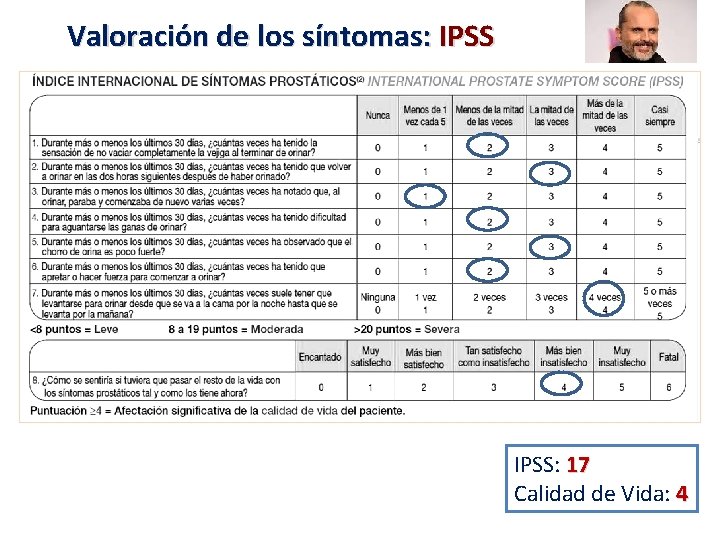 Valoración de los síntomas: IPSS: 17 Calidad de Vida: 4 