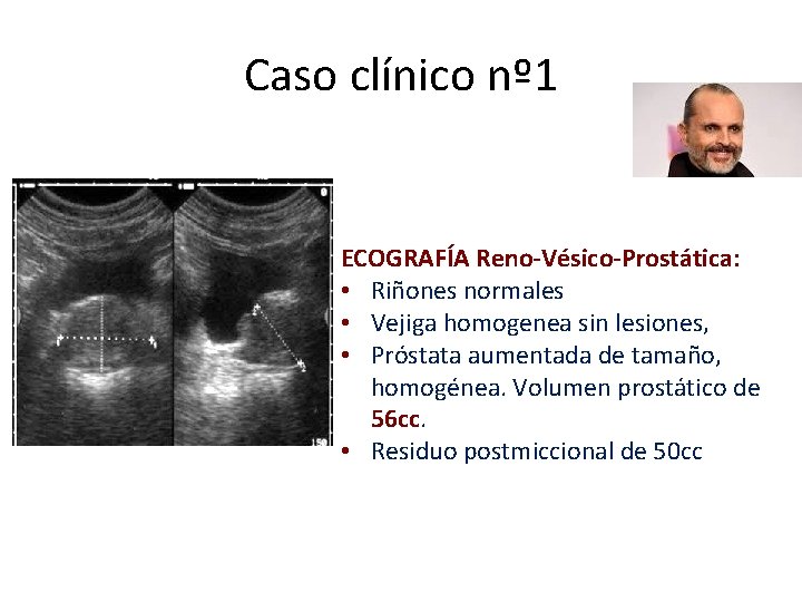Caso clínico nº 1 ECOGRAFÍA Reno-Vésico-Prostática: • Riñones normales • Vejiga homogenea sin lesiones,