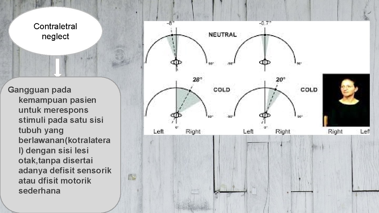 Contraletral neglect Gangguan pada kemampuan pasien untuk merespons stimuli pada satu sisi tubuh yang