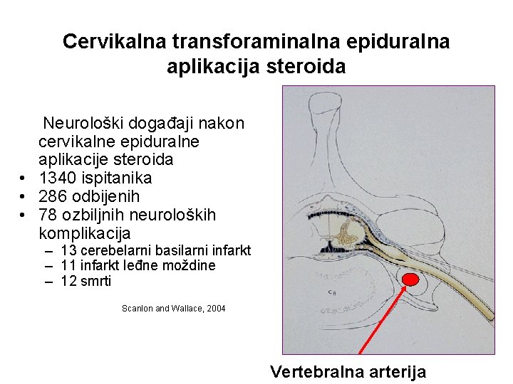 Cervikalna transforaminalna epiduralna aplikacija steroida Neurološki događaji nakon cervikalne epiduralne aplikacije steroida • 1340