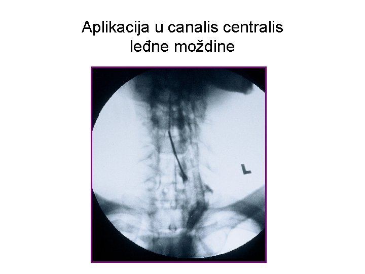 Aplikacija u canalis centralis leđne moždine 