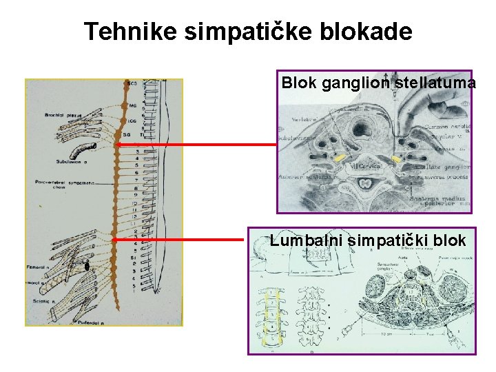 Tehnike simpatičke blokade Blok ganglion stellatuma Lumbalni simpatički blok 