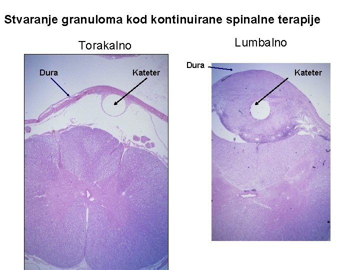 Stvaranje granuloma kod kontinuirane spinalne terapije Lumbalno Torakalno Dura Kateter 