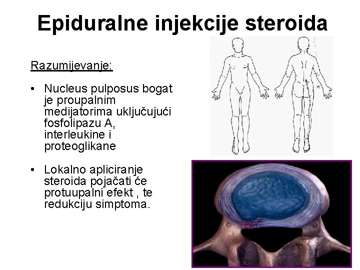 Epiduralne injekcije steroida Razumijevanje: • Nucleus pulposus bogat je proupalnim medijatorima uključujući fosfolipazu A,