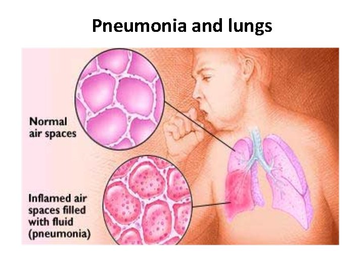 Pneumonia and lungs 