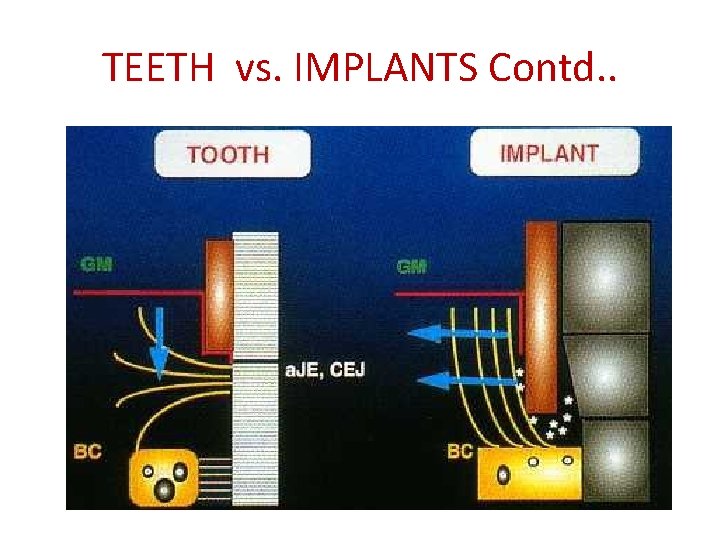 TEETH vs. IMPLANTS Contd. . 