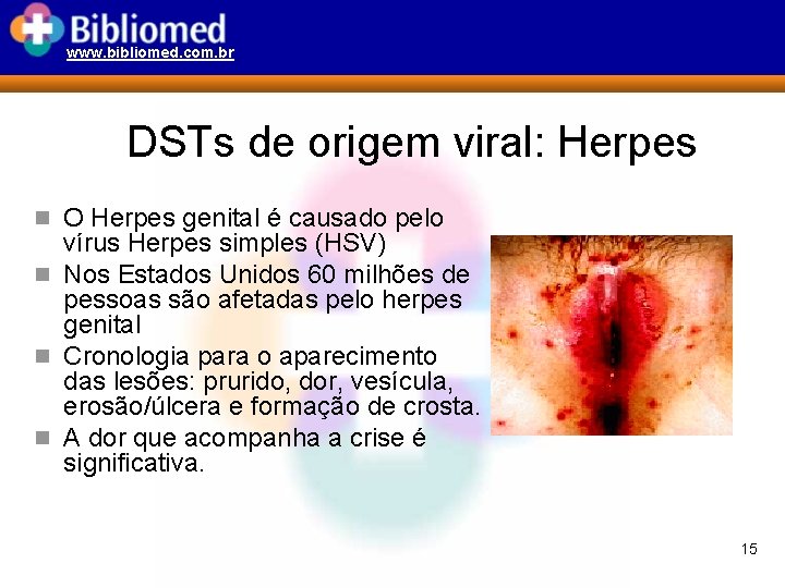 www. bibliomed. com. br DSTs de origem viral: Herpes n O Herpes genital é