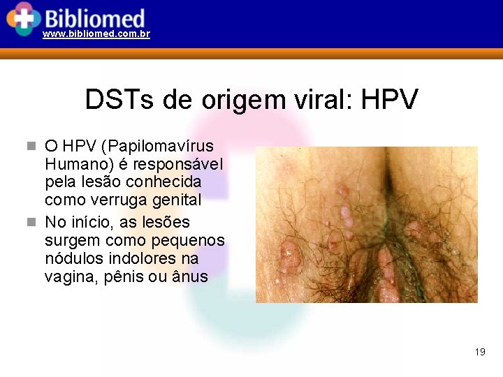 www. bibliomed. com. br DSTs de origem viral: HPV n O HPV (Papilomavírus Humano)