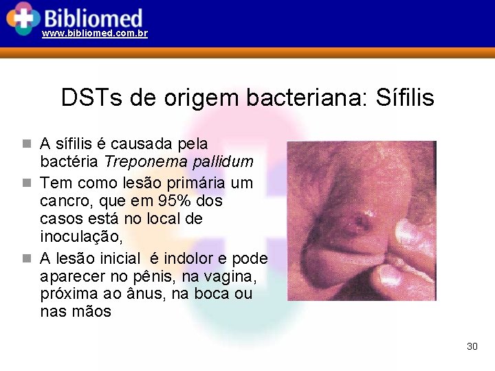 www. bibliomed. com. br DSTs de origem bacteriana: Sífilis n A sífilis é causada