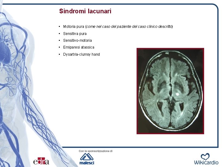 Sindromi lacunari • Motoria pura (come nel caso del paziente del caso clinico descritto)