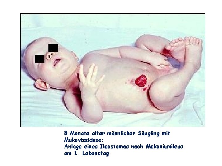 8 Monate alter männlicher Säugling mit Mukoviszidose: Anlage eines Ileostomas nach Mekoniumileus am 1.