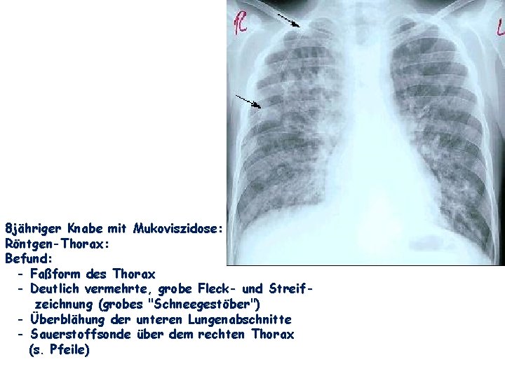 8 jähriger Knabe mit Mukoviszidose: Röntgen-Thorax: Befund: - Faßform des Thorax - Deutlich vermehrte,