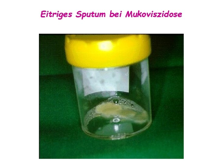 Eitriges Sputum bei Mukoviszidose 