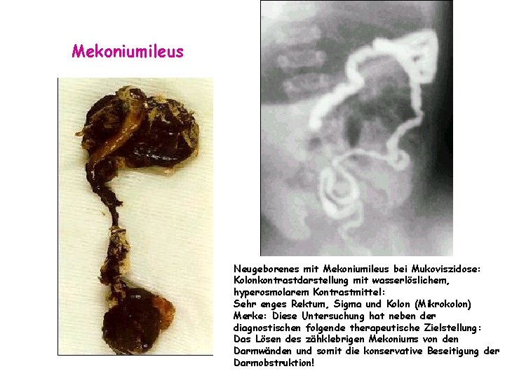 Mekoniumileus Neugeborenes mit Mekoniumileus bei Mukoviszidose: Kolonkontrastdarstellung mit wasserlöslichem, hyperosmolarem Kontrastmittel: Sehr enges Rektum,