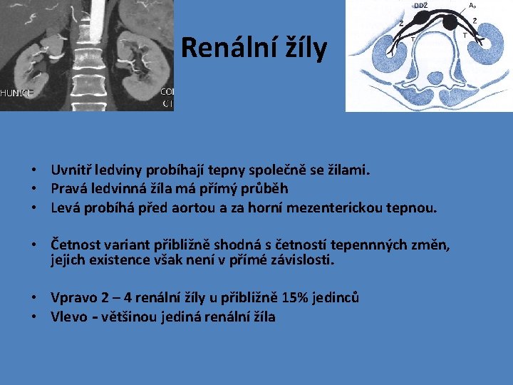 Renální žíly • Uvnitř ledviny probíhají tepny společně se žilami. • Pravá ledvinná žíla