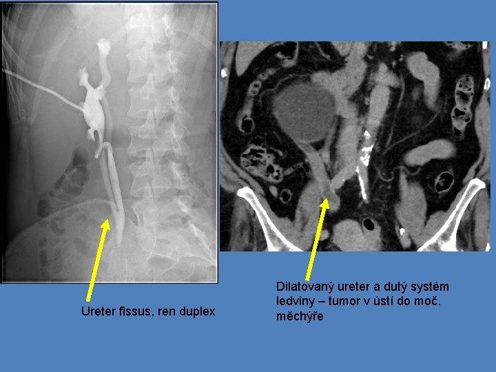 Ureter fissus, ren duplex Dilatovaný ureter a dutý systém ledviny – tumor v ústí