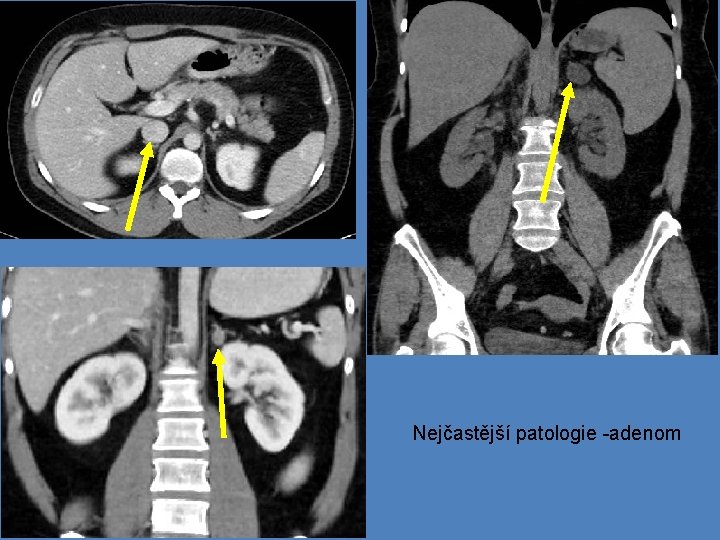 Nejčastější patologie -adenom 